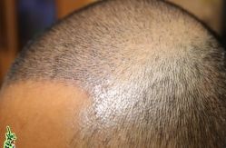 -大麦微针植发丨全国连锁