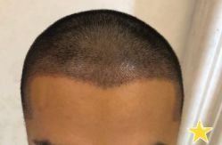 -大麦微针植发丨全国连锁