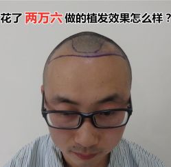 -碧莲盛·不剃发植发