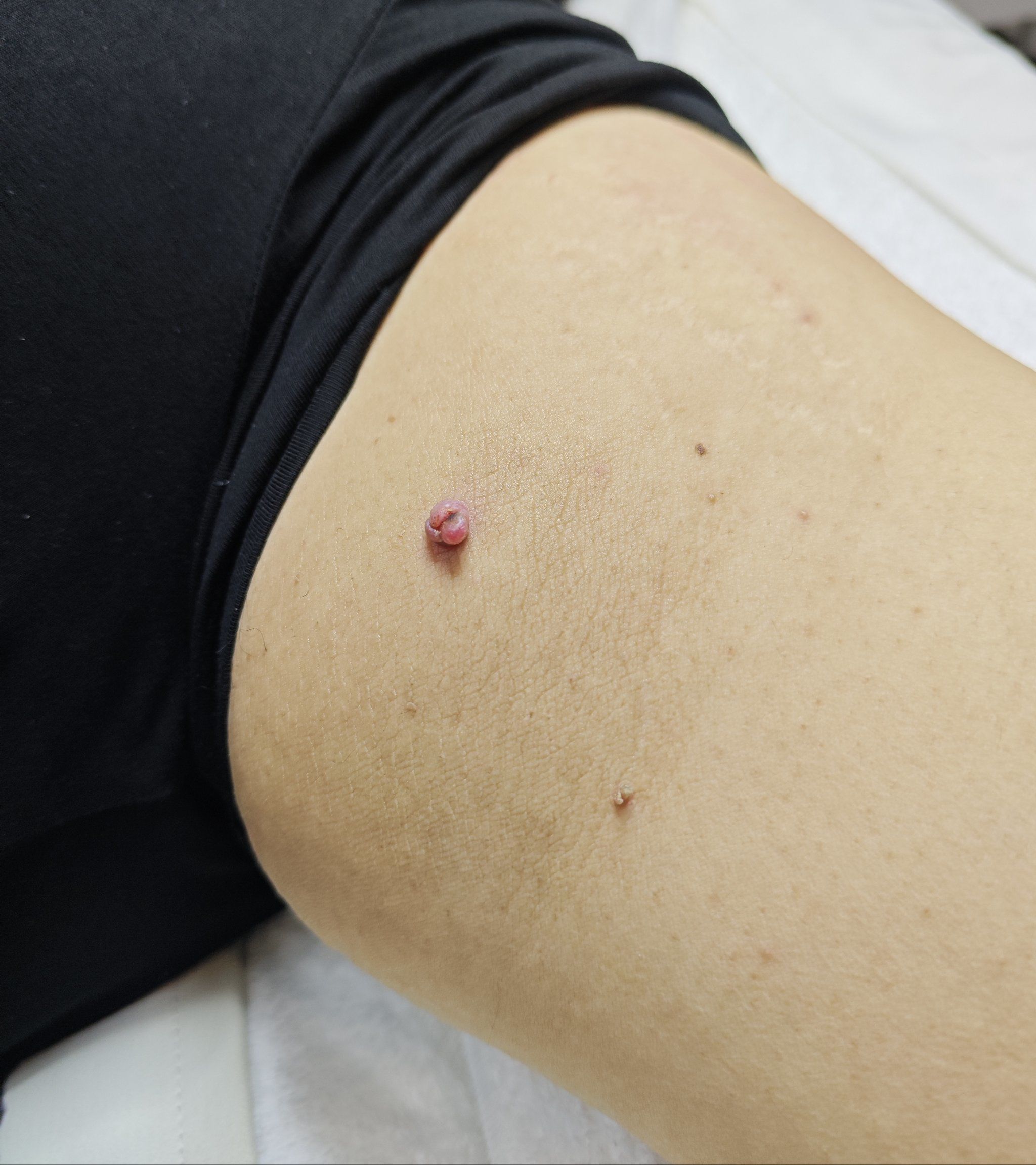 腋下长了一颗疣,飞速发展,半个月长了这么大,本身她有点胖,走路摩擦