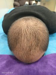 -碧莲盛·不剃发植发