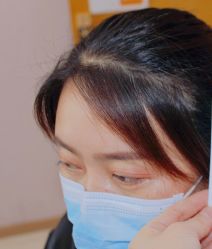 体验后-大麦微针植发全国连锁