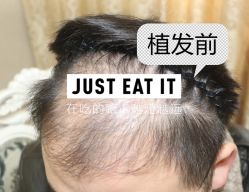 -大麦微针植发全国连锁