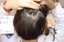 -大麦微针植发丨全国连锁