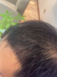 -碧莲盛·不剃发植发