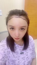 点击看大图 -碧莲盛·不剃发植发