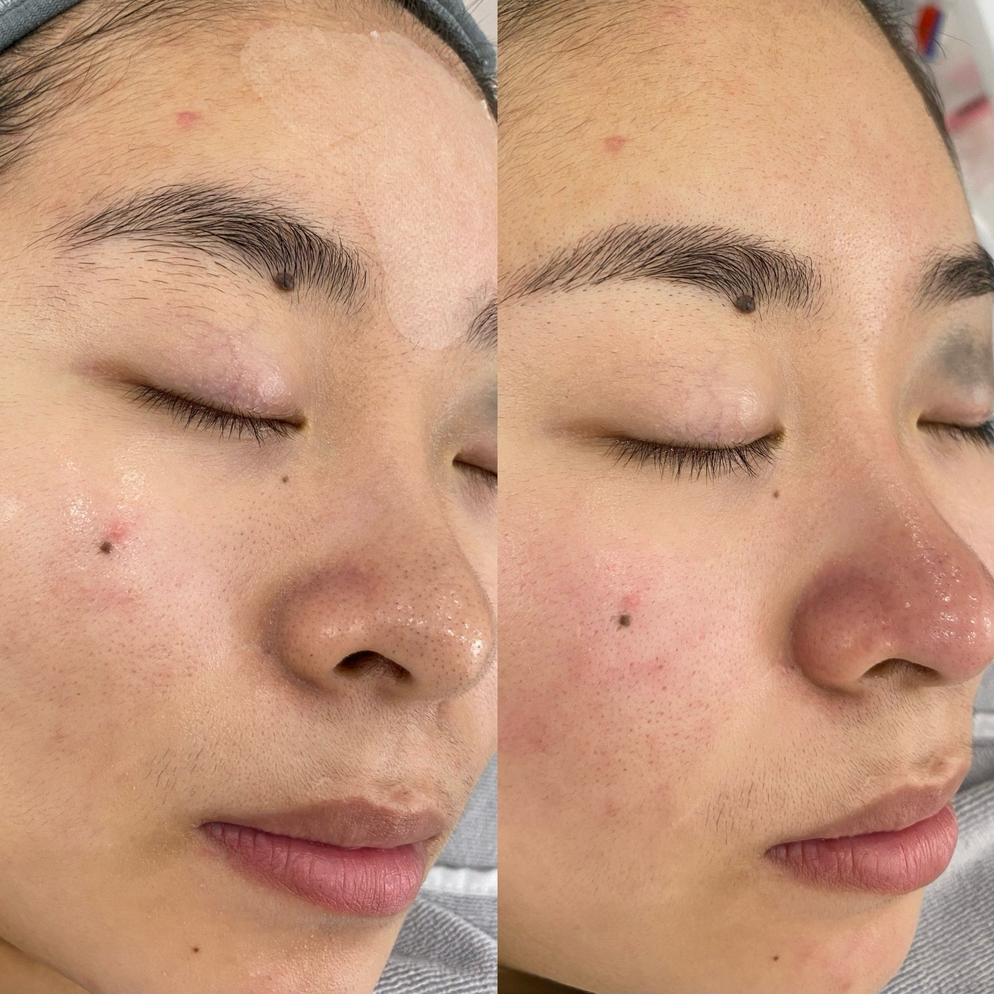 高二学生细胞夹去黑头对比