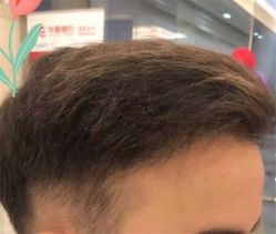 点击看大图 -大麦微针植发全国连锁