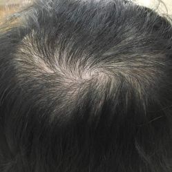 -大麦微针植发全国连锁