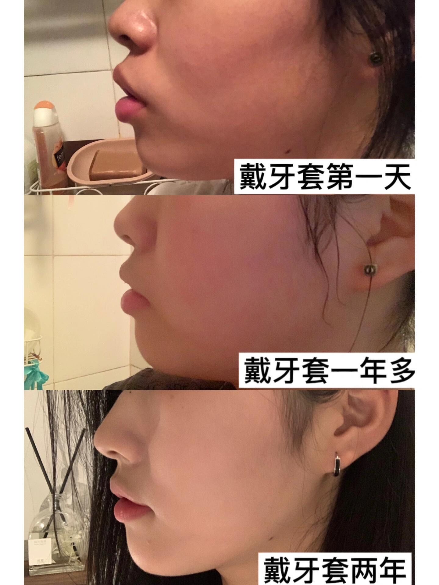 正畸800天对比
