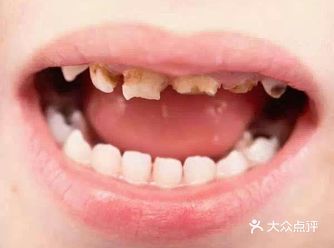 到底是什么原因造成的奶瓶龋？