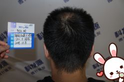 -大麦微针植发丨全国连锁