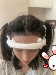 -大麦微针植发丨全国连锁