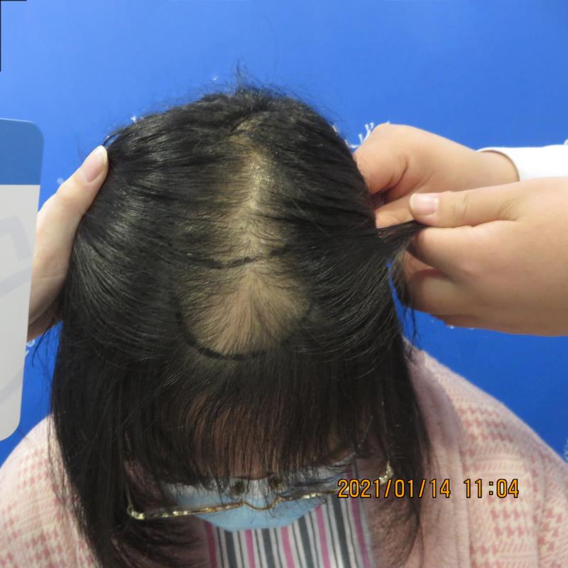 孩子植发年龄(小孩植发最早年龄是多少)