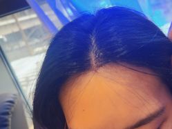 -碧莲盛·不剃发植发