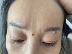 体验后-爱莎扁平疣·汗管瘤·斑痣中心
