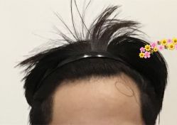 -大麦微针植发全国连锁