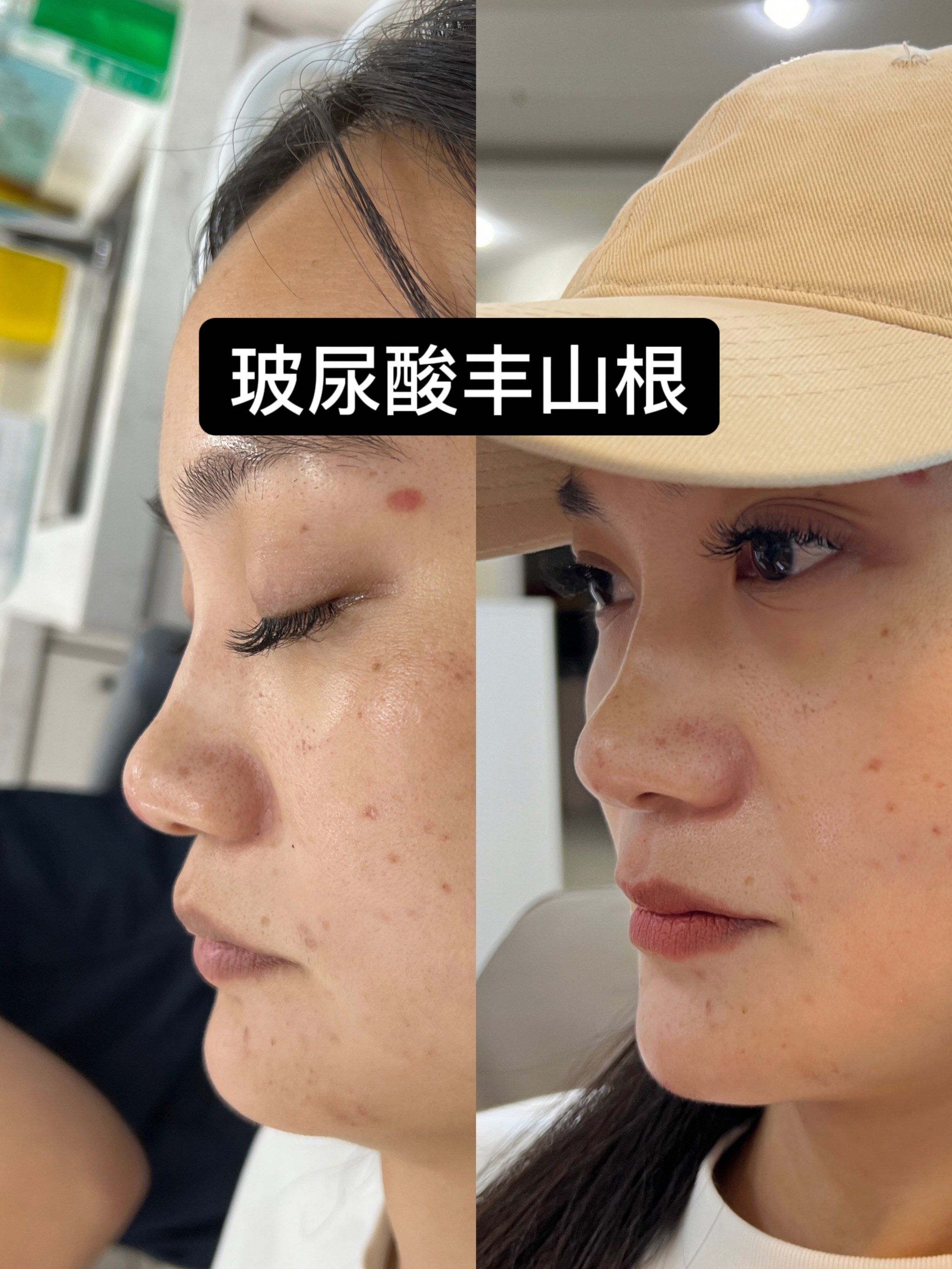 玻尿酸丰山根和下巴,效果绝了