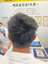 -大麦微针植发全国连锁