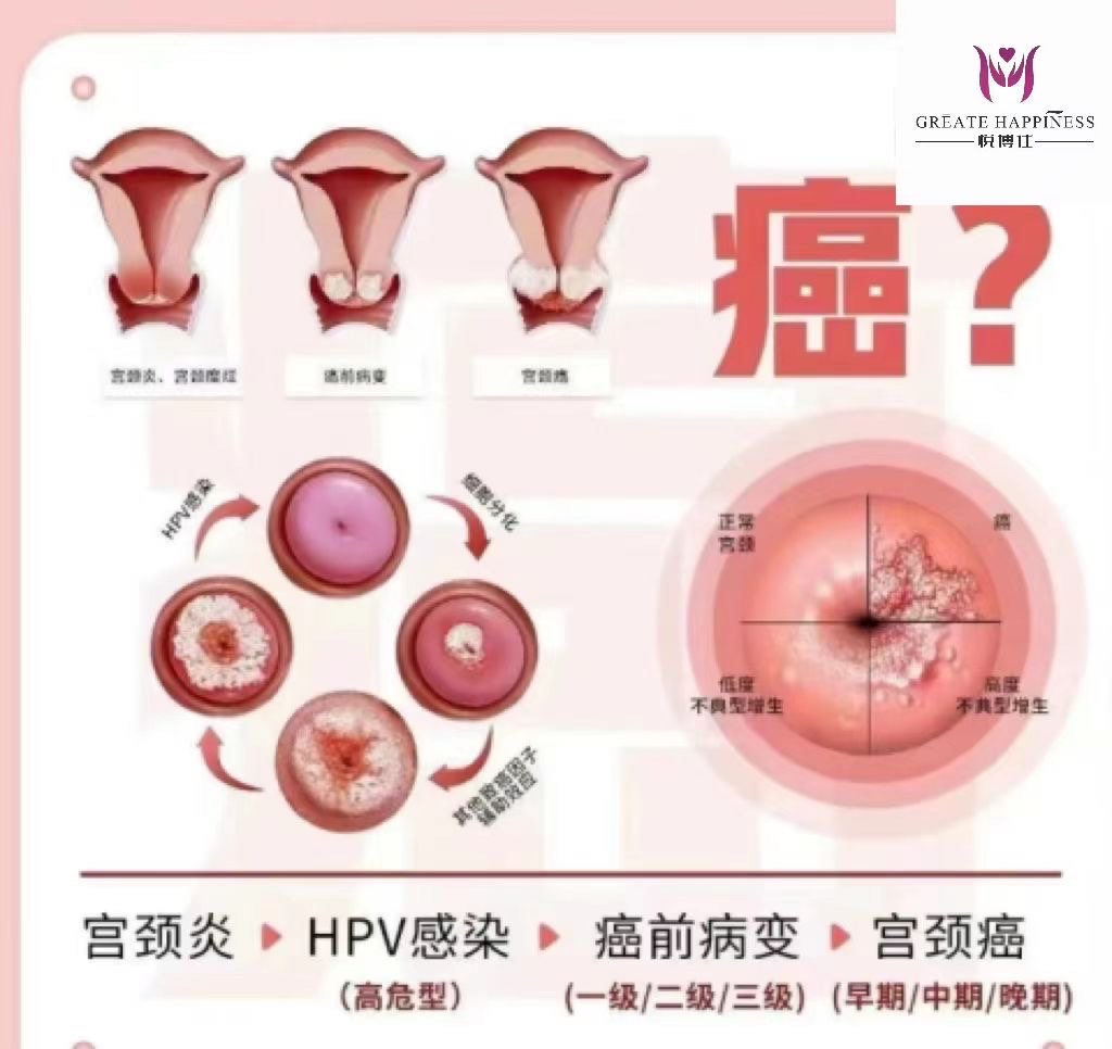 宫颈管炎图片图片