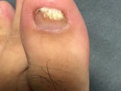 -祖传修脚甲沟炎灰指甲鸡眼