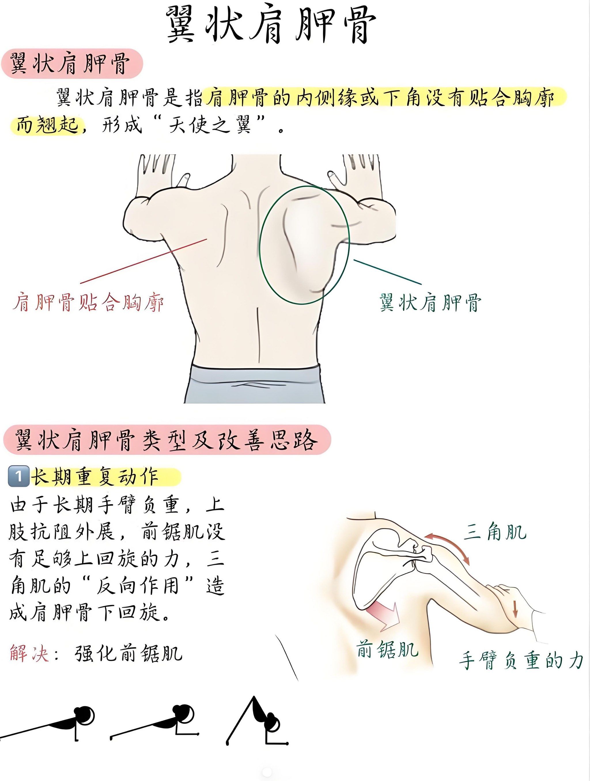翼状肩胛是指肩胛骨内侧缘和下角离开胸壁,出
现如翅膀样的畸形,可