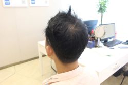 点击看大图 -大麦微针植发丨全国连锁