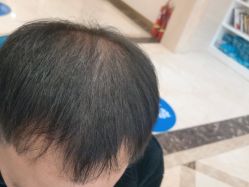 -碧莲盛·不剃发植发