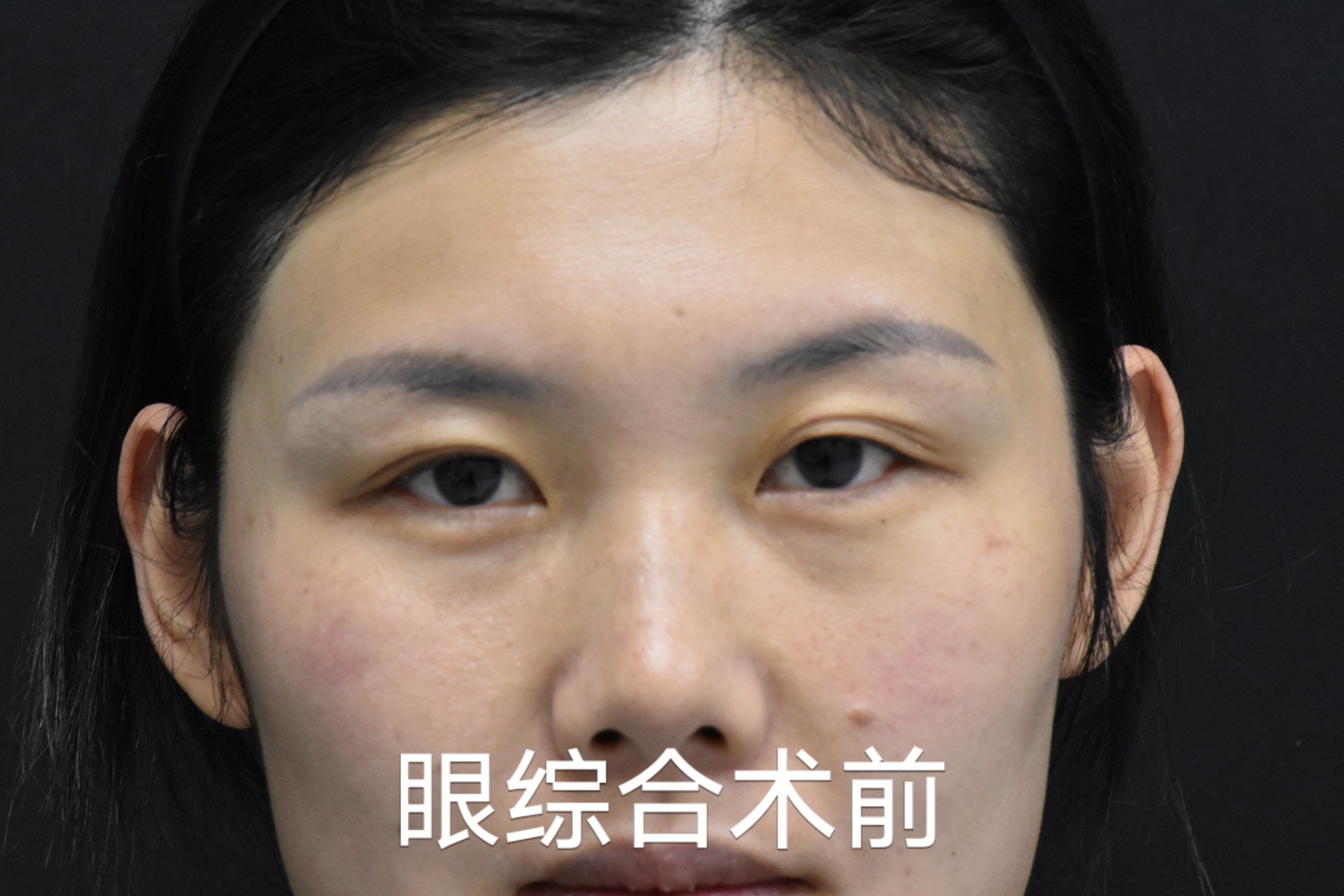 眼综合术后一周效果分享