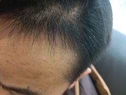 -碧莲盛·不剃发植发