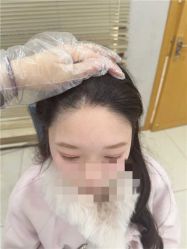 -大麦微针植发丨全国连锁