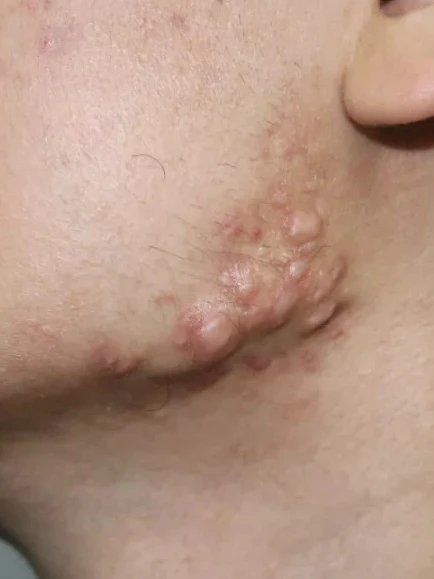 长了痘痘千万不能挤!一旦形成疤痕疙瘩后果