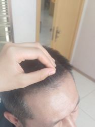 -大麦微针植发丨全国连锁