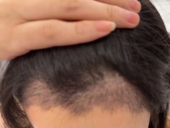 体验后-熙朵美学植发·连锁品牌