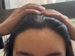 -碧莲盛·不剃发植发