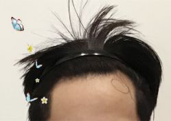 -大麦微针植发全国连锁