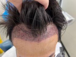 -大麦微针植发全国连锁