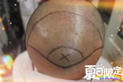 -大麦微针植发全国连锁