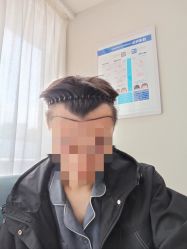体验前-大麦微针植发丨全国连锁