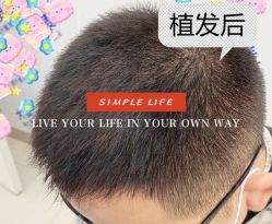 -大麦微针植发全国连锁