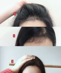 -大麦微针植发全国连锁