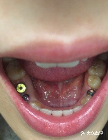 一周通知拆线一个月复查三个月装牙齿
