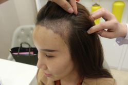 -大麦微针植发丨全国连锁