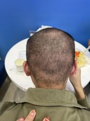 -大麦微针植发全国连锁