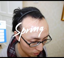 体验前-大麦微针植发全国连锁