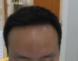 -大麦微针植发丨全国连锁