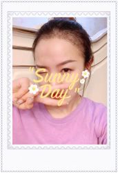 点击看大图 体验后-大麦微针植发全国连锁