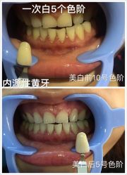 牙齿美白-光SPA科技美肤