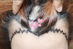 -大麦微针植发全国连锁