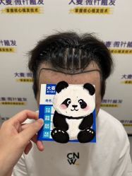 -大麦微针植发全国连锁